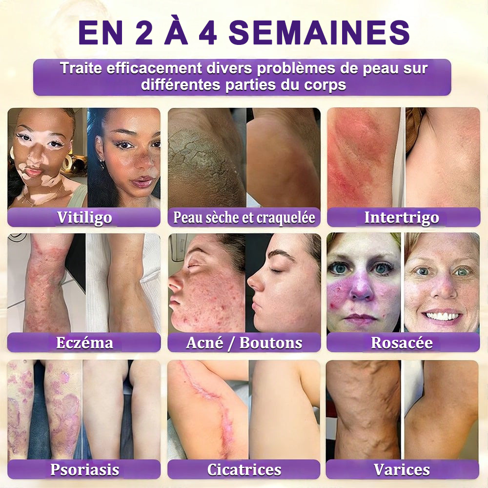 Fabriquée en France et expédiée directement 🍁 Crème réparatrice pour la peau à la biotine Purelora® (formule 10-en-1) — Dernier jour de promotion : -80 %.