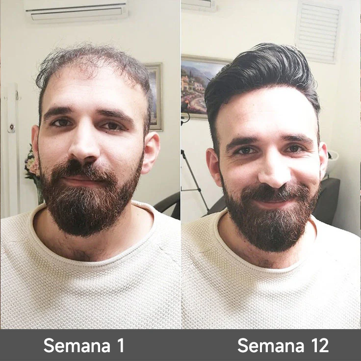 🌿👨‍⚕️ Boutique officielle française | 🔥 Shampoing et après-shampoing 2-en-1 PURELORA® à l'oignon et au romarin — Enrichi d'un complexe actif stimulant la croissance capillaire (concentration x15) pour des cheveux plus épais, plus denses et plus forts.