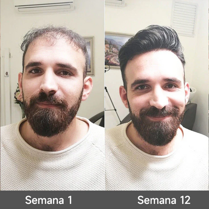 🌿👨‍⚕️ Boutique officielle française | 🔥 Shampoing et après-shampoing 2-en-1 PURELORA® à l'oignon et au romarin — Enrichi d'un complexe actif stimulant la croissance capillaire (concentration x15) pour des cheveux plus épais, plus denses et plus forts.
