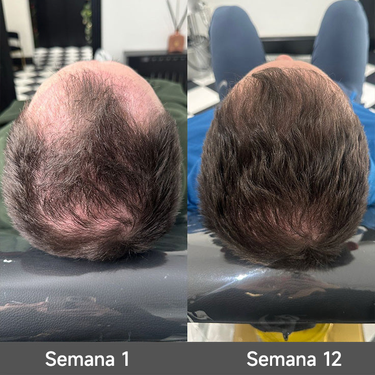 🌿👨‍⚕️ Boutique officielle française | 🔥 Shampoing et après-shampoing 2-en-1 PURELORA® à l'oignon et au romarin — Enrichi d'un complexe actif stimulant la croissance capillaire (concentration x15) pour des cheveux plus épais, plus denses et plus forts.