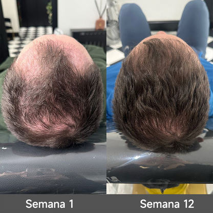 🌿👨‍⚕️ Boutique officielle française | 🔥 Shampoing et après-shampoing 2-en-1 PURELORA® à l'oignon et au romarin — Enrichi d'un complexe actif stimulant la croissance capillaire (concentration x15) pour des cheveux plus épais, plus denses et plus forts.