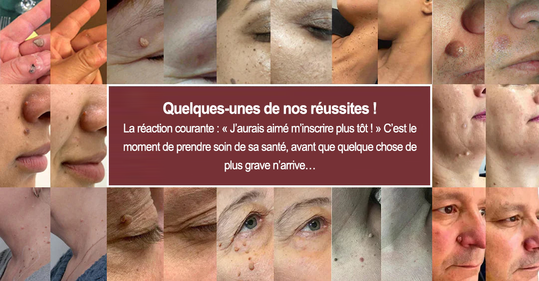✨Patch 2-en-1 Curalona® : Microneedle & Hydrocolloïde🍀 | Élimine les grains de beauté en relief, les verrues planes et les acrochordons | Aide à atténuer les rides, les cicatrices et les imperfections | Patch invisible adapté au visage et au corps
