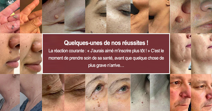 ✨Patch 2-en-1 Curalona® : Microneedle & Hydrocolloïde🍀 | Élimine les grains de beauté en relief, les verrues planes et les acrochordons | Aide à atténuer les rides, les cicatrices et les imperfections | Patch invisible adapté au visage et au corps