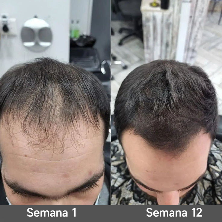 🌿👨‍⚕️ Boutique officielle française | 🔥 Shampoing et après-shampoing 2-en-1 PURELORA® à l'oignon et au romarin — Enrichi d'un complexe actif stimulant la croissance capillaire (concentration x15) pour des cheveux plus épais, plus denses et plus forts.