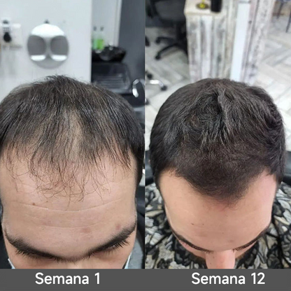 🌿👨‍⚕️ Boutique officielle française | 🔥 Shampoing et après-shampoing 2-en-1 PURELORA® à l'oignon et au romarin — Enrichi d'un complexe actif stimulant la croissance capillaire (concentration x15) pour des cheveux plus épais, plus denses et plus forts.