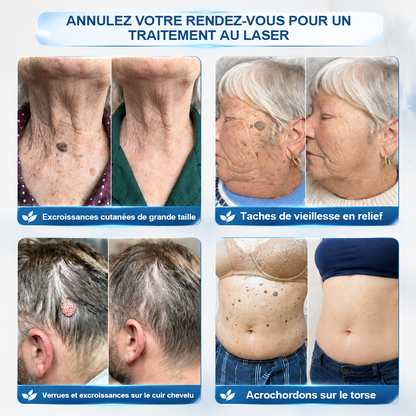𝐁𝐨𝐮𝐭𝐢𝐪𝐮𝐞 𝐨𝐟𝐟𝐢𝐜𝐢𝐞𝐥𝐥𝐞 𝐝𝐞 𝐥𝐚 𝐦𝐚𝐫𝐪𝐮𝐞 |✅💎Purelora® Éliminateur de taches et d’excroissances cutanées en 7 jours (Roller sans douleur, sans cicatrice)