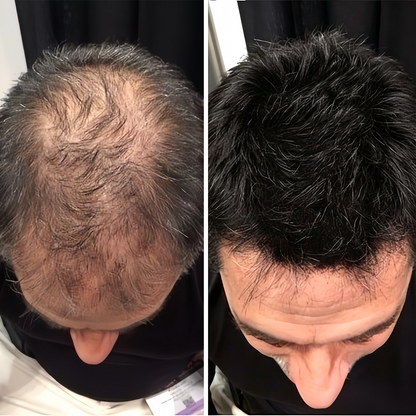 🌿👨‍⚕️ Boutique officielle française | 🔥 Shampoing et après-shampoing 2-en-1 PURELORA® à l'oignon et au romarin — Enrichi d'un complexe actif stimulant la croissance capillaire (concentration x15) pour des cheveux plus épais, plus denses et plus forts.