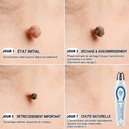 𝐁𝐨𝐮𝐭𝐢𝐪𝐮𝐞 𝐨𝐟𝐟𝐢𝐜𝐢𝐞𝐥𝐥𝐞 𝐝𝐞 𝐥𝐚 𝐦𝐚𝐫𝐪𝐮𝐞 |✅💎Purelora® Éliminateur de taches et d’excroissances cutanées en 7 jours (Roller sans douleur, sans cicatrice)