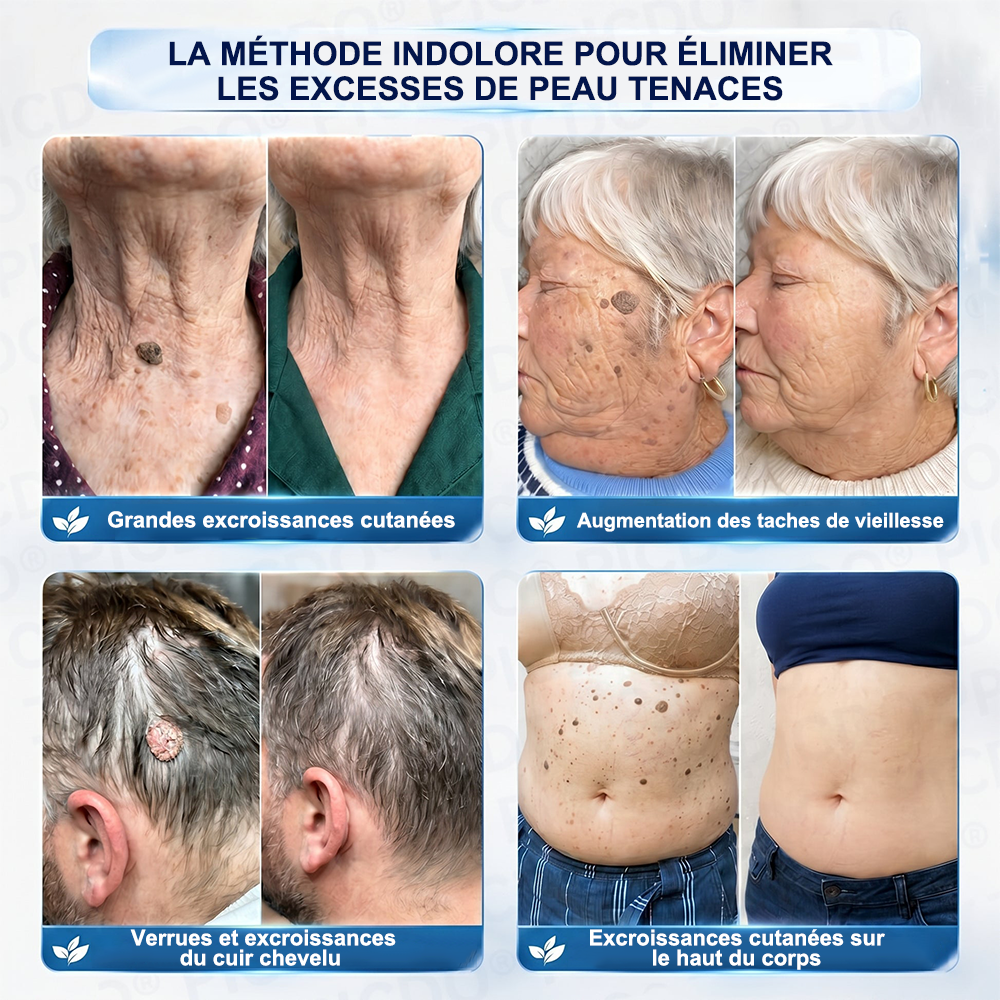 Crème PURELORA® pour l'élimination des acrochordons et des imperfections en 7 jours (formule indolore – sans cicatrice) 🌹🌹