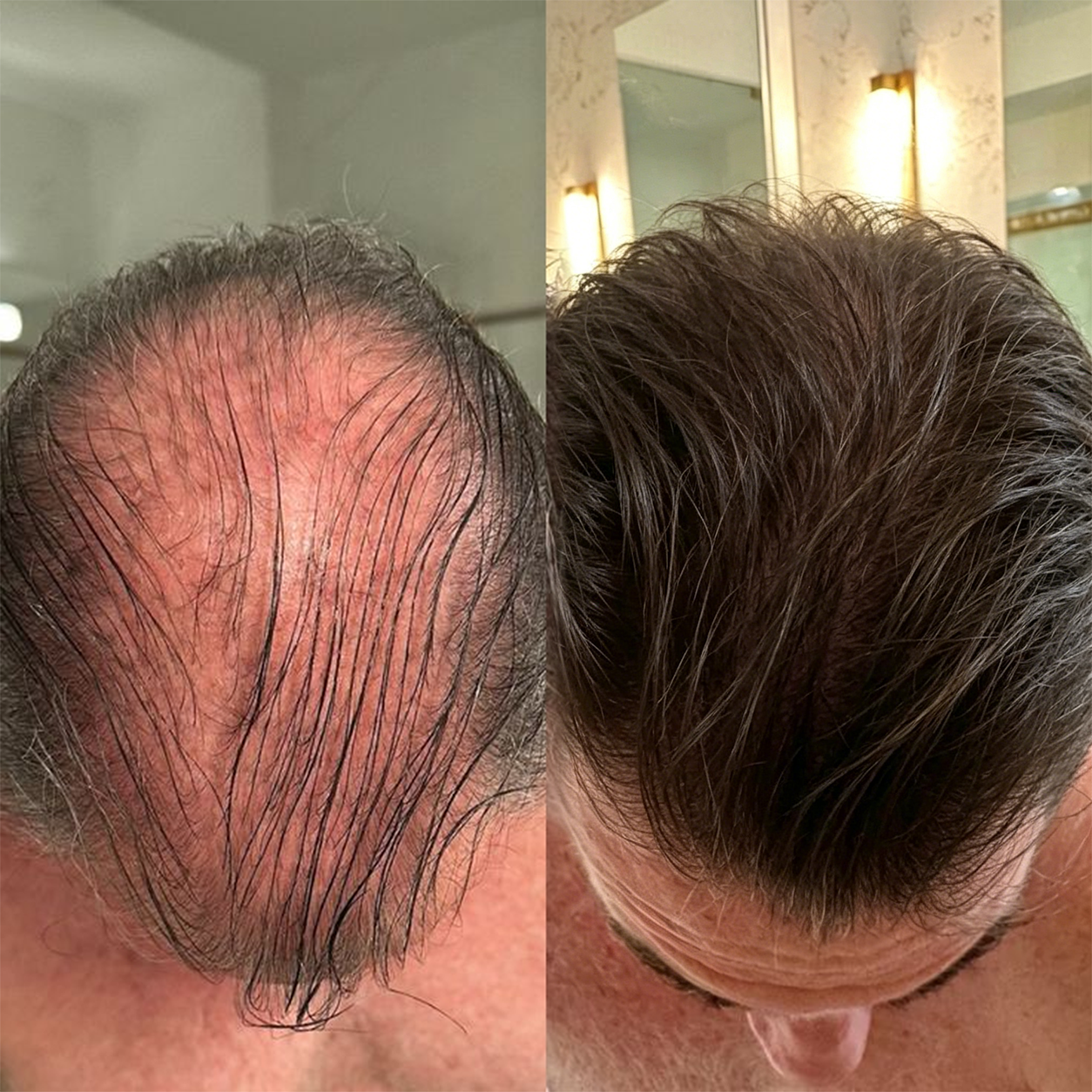 🌿👨‍⚕️ Boutique officielle française | 🔥 Shampoing et après-shampoing 2-en-1 PURELORA® à l'oignon et au romarin — Enrichi d'un complexe actif stimulant la croissance capillaire (concentration x15) pour des cheveux plus épais, plus denses et plus forts.
