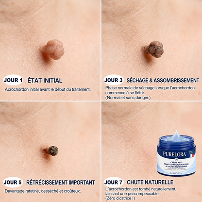 Crème PURELORA® pour l'élimination des acrochordons et des imperfections en 7 jours (formule indolore – sans cicatrice) 🌹🌹