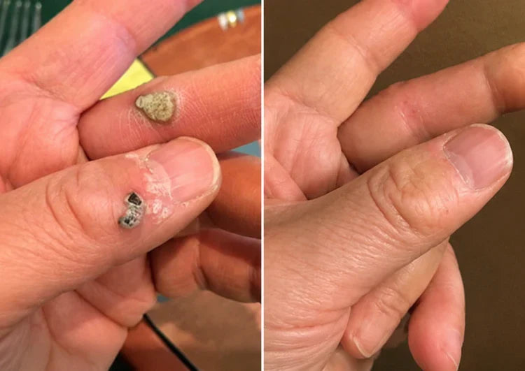 ✨Patch 2-en-1 Curalona® : Microneedle & Hydrocolloïde🍀 | Élimine les grains de beauté en relief, les verrues planes et les acrochordons | Aide à atténuer les rides, les cicatrices et les imperfections | Patch invisible adapté au visage et au corps