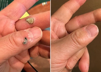 ✨Patch 2-en-1 Curalona® : Microneedle & Hydrocolloïde🍀 | Élimine les grains de beauté en relief, les verrues planes et les acrochordons | Aide à atténuer les rides, les cicatrices et les imperfections | Patch invisible adapté au visage et au corps